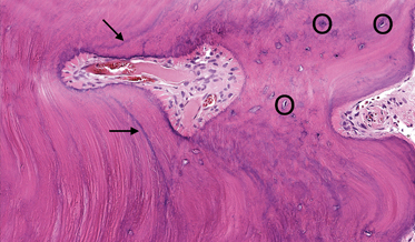 Cementoblastoma Mimicking Pathology of Endodontic Origin