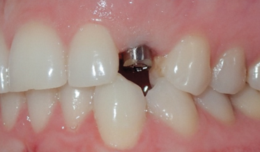 Implant Placement When an Impacted Tooth and Supernumerary Teeth Are Present in the Maxilla