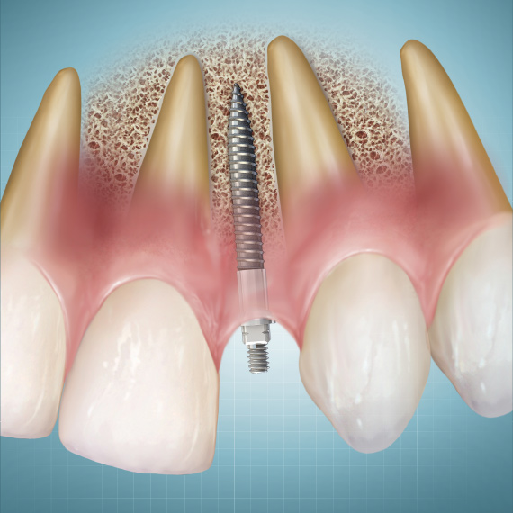 Implantology Ebook Library Image