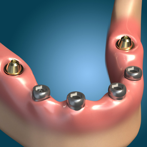 Implant Solutions for the Edentulous Patient Ebook Library Image