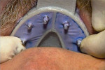 View of the tray fully seated on the maxillary arch to capture the five implants with the long pins of the open tray impression heads protruding through the clear foil.