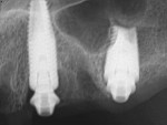Fig 41 and Fig 42. Postoperative periapical x-rays on the day of surgery demonstrating ideal immediate implant placement in bone.