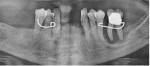Fig 44. Preoperative, generalized horizontal bone loss was evident with extensive bone loss and alveolar destruction in the mandibular left molar area.