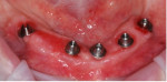 Fig 46. The fixed provisional restoration was removed, and the multi-unit abutments were scanned with the surrounding fixed soft tissue.