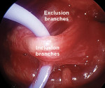 Fig 6. Included branches of the nerve (C1 and protrusor fibers) are isolated with a vessel loop.