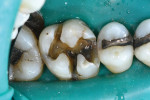 Fig 1. Occlusal view of first molar after removal of a failing mesial-occlusal-lingual amalgam restoration that was showing signs of dentin cracks. Complete elimination of such cracks can be challenging.