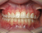 Fig 11. Post-orthodontic treatment and post-composite restorations, retracted view.