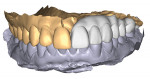 Fig 9. Exocad (exocad) virtual reconstruction. A 3D-printed (SprintRay) interim restoration will be made 3 months after the surgery to provide teeth and re-establish function while the healing process is completed.