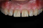 Fig 3. The anterior wear, chipping, and diastemas were very apparent against the black contraster. Note, also, the unevenness on both sides of the dentition.