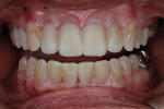 Fig 4. A trial smile, or initial mock-up, was placed over the existing teeth using a bis-acryl temporary material. A polyvinyl siloxane (PVS) putty matrix was made on a printed digital wax-up model using a 3D printer (SprintRay). This matrix was then used to complete the trial smile, which verified the esthetic requirements for the patient.