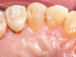 (1.) Pretreatment photograph of root caries on the palatal aspect of tooth No. 5, which developed after the tooth received a zirconia crown approximately 12 months prior.
