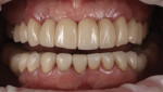 Fig 8. Final restorative result after removal of cured excess resin cement.