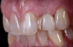 Fig 9. Initial situation showing failed resin-bonded pontic, maxillary left lateral incisor.