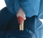 Fig 13. Seating of the all-ceramic crown on the copy abutment to displace excess
cement just prior to final delivery.