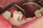 (8.) An Orban knife was used to make a precise incision slightly lingual to the center of the crest in order to harvest a band of attached gingiva that would later be repositioned to the facial aspect of a tall healing abutment. No vertical incisions were made into the mucosa. When incisions are limited to the attached gingiva, prostaglandins and histamine are not released, and thus, there is nominal postoperative discomfort for the patient.