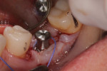 (16.) A periodontal sling suture was used to reposition the band of attached gingiva on the buccal flap from the slightly lingual aspect of the crest to the facial aspect of the healing abutment. To accomplish this, a reverse cutting, 3/8-circle needle was engaged on the mesial-facial aspect of the attached gingiva. After the suture was wrapped around the healing abutment without engaging the lingual tissue at all, the needle was reversed, engaging the distal-facial aspect of the attached gingiva, and again the suture was wrapped around the healing abutment without engaging the lingual tissue. A knot was tied on the mesial facial aspect. The exposed bone at the crestal aspect of the site was left untouched. Epithelium will fill that space at a rate of approximately 0.5 mm per day.