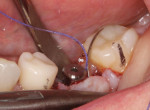 (17.) A periodontal sling suture was used to reposition the band of attached gingiva on the buccal flap from the slightly lingual aspect of the crest to the facial aspect of the healing abutment. To accomplish this, a reverse cutting, 3/8-circle needle was engaged on the mesial-facial aspect of the attached gingiva. After the suture was wrapped around the healing abutment without engaging the lingual tissue at all, the needle was reversed, engaging the distal-facial aspect of the attached gingiva, and again the suture was wrapped around the healing abutment without engaging the lingual tissue. A knot was tied on the mesial facial aspect. The exposed bone at the crestal aspect of the site was left untouched. Epithelium will fill that space at a rate of approximately 0.5 mm per day.