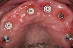 (12.) View of the multi-unit abutments placed on the implants.