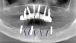 (2.) Virtual planning of the positions and angulations of five new implants to be placed in the mandible following recovery of the failing ones.