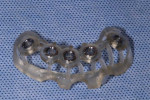 (8.) The 3D printed surgical guide, which was created with appliance resin.