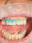 (5.) Application of a 38% phosphoric acid etchant for 15 seconds. After it was subsequently rinsed, a bonding agent was scrubbed into the areas for 20 seconds, air thinned, and light cured for 10 seconds per tooth.