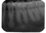 Fig 1. Preoperative 2-dimensional
periapical radiograph showing a
radiopacity overlying the apex
of tooth No. 20.