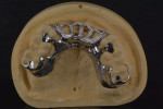 (12.) Occlusal view of the completed rotational path removable partial denture framework (Vitallium® Partial Denture System, Dentsply Sirona), which was fabricated using a wax and cast methodology, seated on the master cast.