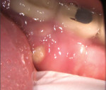 Fig 1. Intraoral photograph of the mandibular left
lingual torus with a 7-mm area of exposed bone.