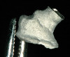 Figure 6  Restoration fracture. Fractured isthmus of an amalgam restoration.