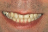 (1.) Full-face smile photo. The blue line represents the vertical line between the nasion and the center of the philtrum of the upper lip. The upper red line represents the interpupillary line and the lower red line represents the maxillary incisal plane.