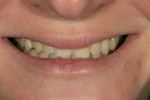 Figure 10  Preoperative view of the patient’s natural smile.