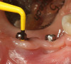 Fig 14. Short implants used to avoid grafting. Fig 13: Occlusal view of a full-arch fixed dental prosthesis supported by five endosseous
implants placed. Fig 14: The left distal implant was tilted to support the left molar unit of the prosthesis. Fig 15: A 6 mm x 5.4 mm implant
was used to support the right molar unit of the prosthesis. The strategic application of nongrafted solutions helped accelerate treatment and
reduce treatment costs.