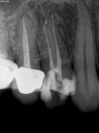 Figure 4 Postoperative radiograph of tooth No. 5 after root canal using PIPS protocol with LightWalker Er:YAG laser.