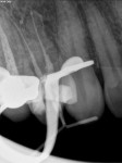 Figure 5 Postoperative radiograph of tooth No. 5 after root canal using PIPS protocol with LightWalker Er:YAG laser.