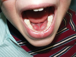 Figure 7 Frenectomy performed on 4-year-old patient with ankyloglossia and speech difficulties using topical anesthesia only and an Er,Cr:YSGG laser.