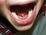 Figure 6 Frenectomy performed on 4-year-old patient with ankyloglossia and speech difficulties using topical anesthesia only and an Er,Cr:YSGG laser.