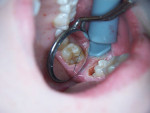Figure 2 A gingivectomy was performed with the soft-tissue laser settings, then the occlusal preparation was performed with the same laser set on the hard-tissue settings.