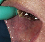 Figure 10 Patient before, at, and 6 months after fibroma excision with an Er:YAG laser.