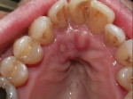 Figure 13 Lesion re-epithelialization had already begun 48 hours after this palatal herpes patient received combined laser therapy using Nd:YAG and Er:YAG lasers.