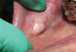 Figure 8 Patient before, at, and 6 months after fibroma excision with an Er:YAG laser.