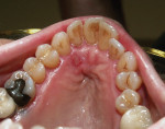 Figure 12 Lesion re-epithelialization had already begun 48 hours after this palatal herpes patient received combined laser therapy using Nd:YAG and Er:YAG lasers.