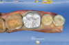 Figure 1  Susceptible pit and fissures on occlusal surface of molar.
