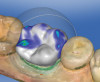 Figure 3  Etching the occlusal surface.