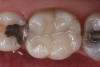 Fig 18. Buccal view at 15 months postoperative. Health was restored to the site with mostly 4 mm probing depths and absence of bleeding. Some interproximal and facial recession of the gingiva had occurred.