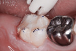 Figure 13 The occlusal contacts were then evaluated.