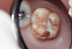 Figure 19 This molar had pervasive enamel hypoplasia, enamel hypocalcification malformation, and caries, with remnants of previously placed resin-based composite repair material. Full coronal restoration was necessary.