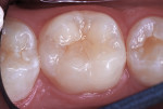 Figure 13 Postoperative view of restored tooth at 31 months.