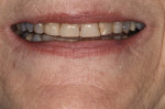 Functional and esthetic changes are verified three times prior to definitive restorations. This helps ensure predictable success. The
preoperative smile is shown here.