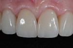 Definitive restorations predictably achieved following a proven stepwise protocol.