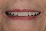 Definitive restorations predictably achieved following a proven stepwise protocol.